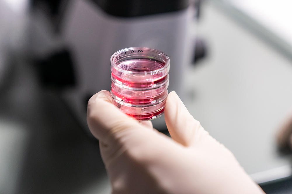 The researchers are analyzing tumor cell samples from the Charité biobank. They want to identify the molecular characteristics of tumors that have responded well to hyperthermia therapy.